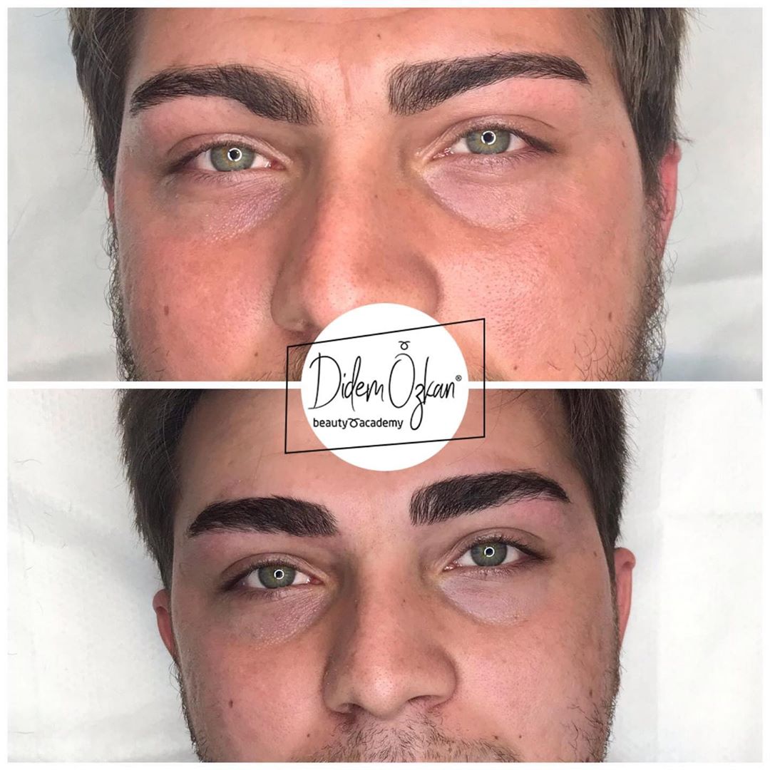 “4D ANATOMIC MALE EYEBROW DESIGN MIT VITAMIN PROTOKOLL”
Mehmet unsere Klinik …