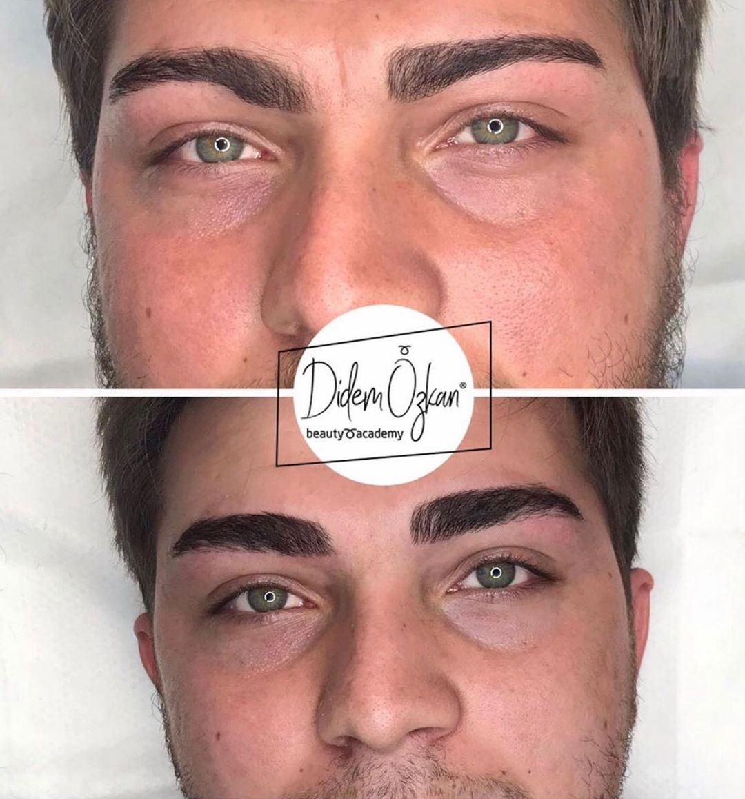 4D Anatomic Male Eyebrow Design mit Vitamin-Protokoll
Mehmet ist falsch in unserer Klinik …